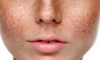 از بین بردن لکه‌های قهوه‌ای پوست با چند راهکار خانگی ساده