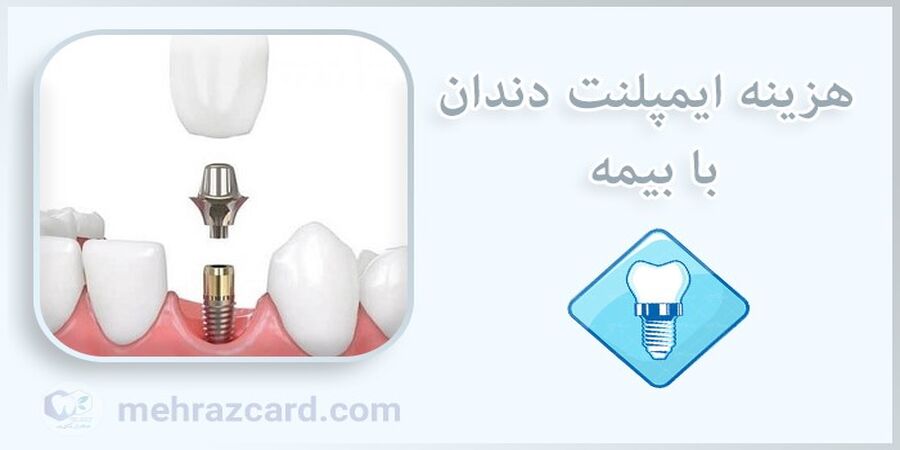 هزینه ایمپلنت دندان با بیمه
